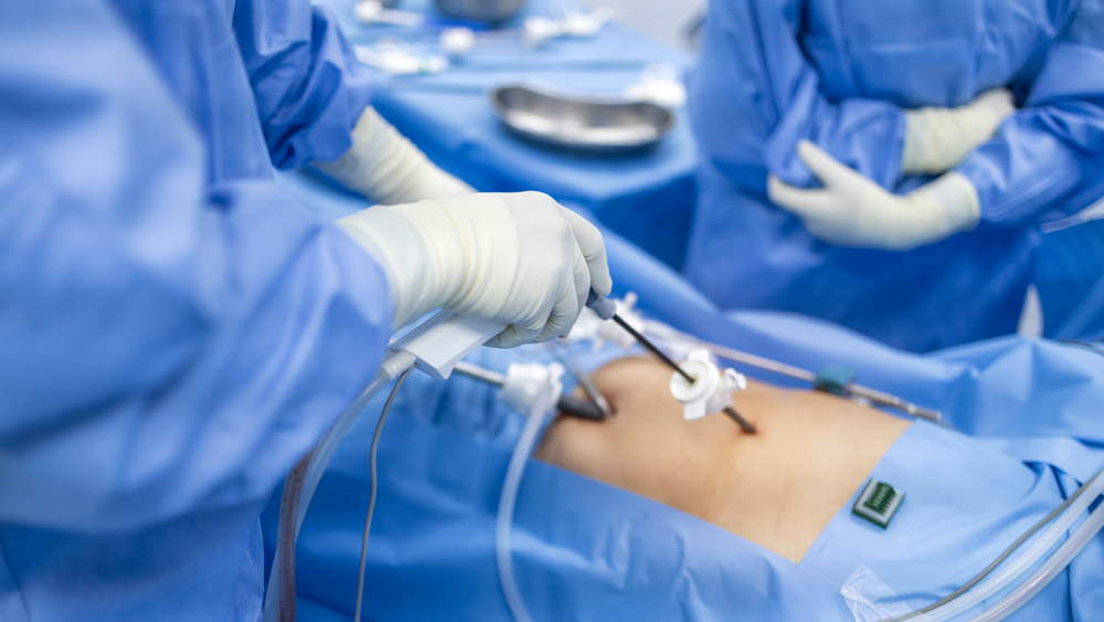Surgeon,Perform,Laparoscopic,Cholecystectomy,In,Gall,Stone,Patient,With,Abdominal