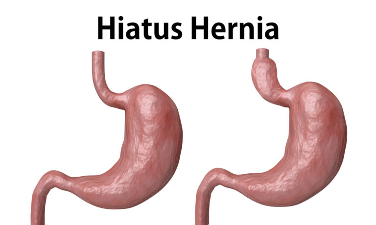 The hiatal hernia is the advancement of part of the stomach towards the esophagus, isolated over white background. 3D rendering