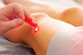 safenectomia laser